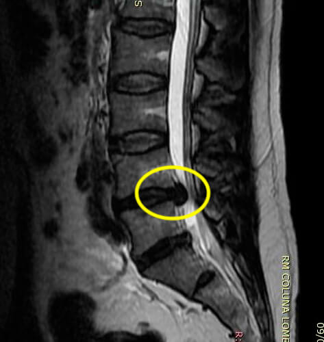 Ressonância magnética de um paciente humano mostrando hérnia de disco no final da coluna (círculo em L4-5) causando grande compressão.